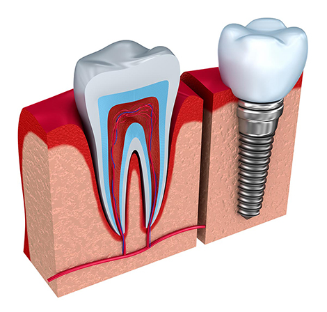dental implant treatment